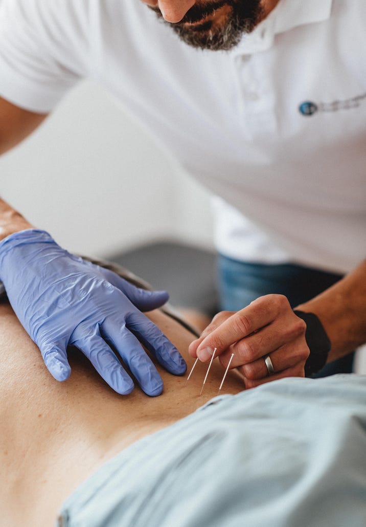 Dry Needling behandelt myofasziale Triggerpunkte in Muskeln durch gezieltes Einstechen einer dünnen Nadel, um muskuläre Dysfunktionen zu lösen und Schmerzen zu reduzieren. Es wird ohne Medikamente oder Flüssigkeiten durchgeführt, daher der Name "trockenes" Needling.