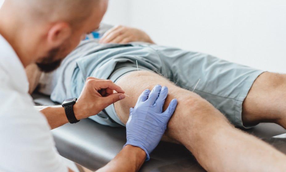 Dry Needling behandelt myofasziale Triggerpunkte in Muskeln durch gezieltes Einstechen einer dünnen Nadel, um muskuläre Dysfunktionen zu lösen und Schmerzen zu reduzieren. Es wird ohne Medikamente oder Flüssigkeiten durchgeführt, daher der Name "trockenes" Needling.